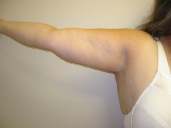 Arm Lift