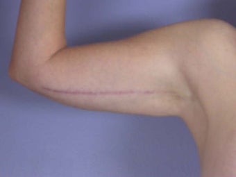 Arm Lift