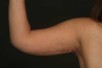 Arm Lift