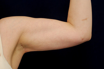 Liposuction - Upper Arms