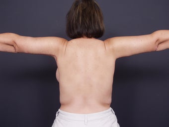 42 year old with sagging arm skin