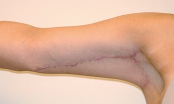 Brachioplasty (Arm Lift) After Massive Weight Loss (Front View)