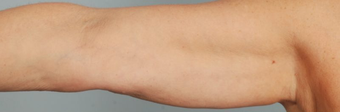 Brachioplasty