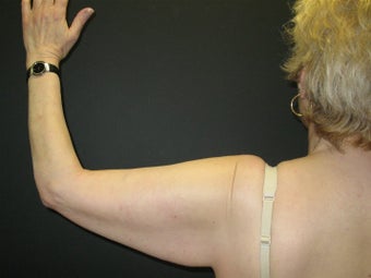 Arm Lift