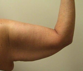 Brachioplasty