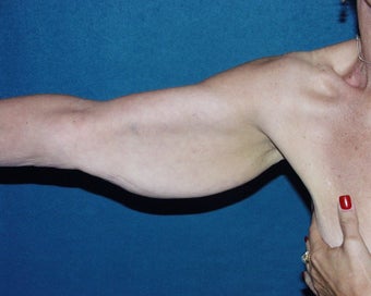 Brachioplasty