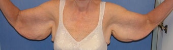 Brachioplasty