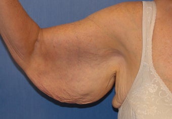 Brachioplasty
