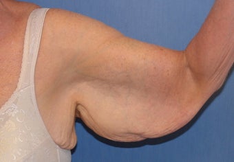 Brachioplasty