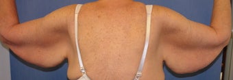 Brachioplasty