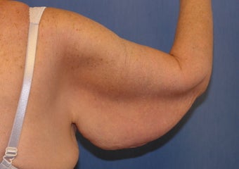 Brachioplasty