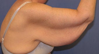 Brachioplasty