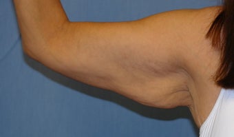 Brachioplasty