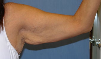 Brachioplasty