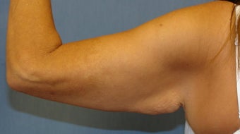 Brachioplasty