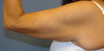 Brachioplasty