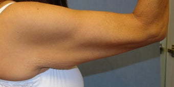 Brachioplasty