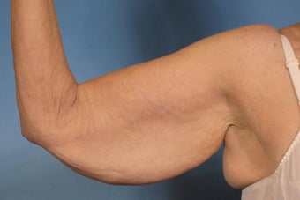 Arm Lift 