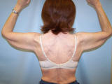 Arm Lift Surgery