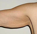 Arm Lift (Brachioplasty)