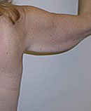 Arm Lift (Brachioplasty)