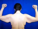 Arm Lift Surgery (Brachioplasty)