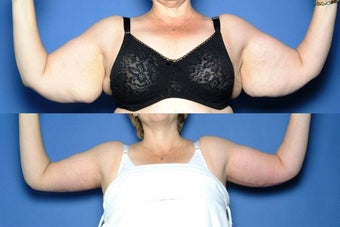 Arm Lift