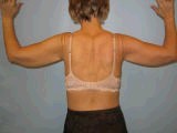 Arm Lift Surgery (Brachioplasty)