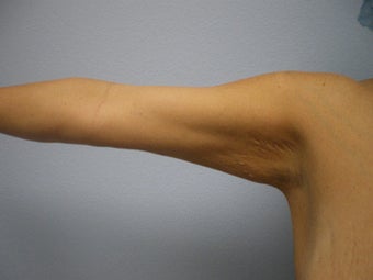 Arm Lift 