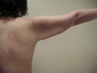 Arm Lift