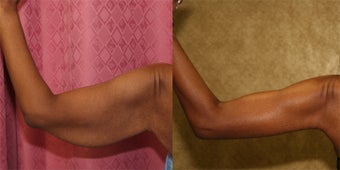 brachioplasty