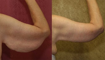 arm lift or brachioplasty