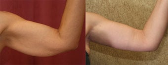 brachioplasty