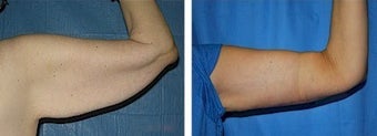 Arm lift