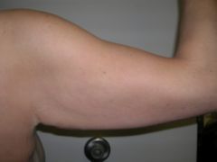 Arm Lift