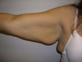 Arm Lift
