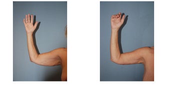 Arm Lift 