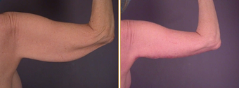Arm Lift
