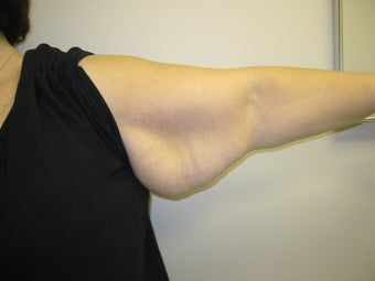 Brachioplasty