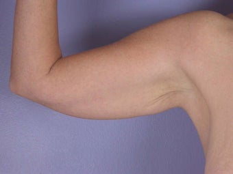 Arm Lift