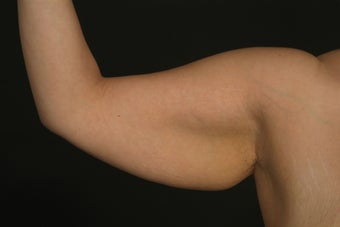 Arm Lift