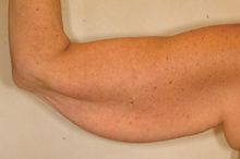 Brachioplasty (Arm Lift)
