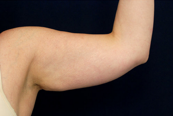Liposuction - Upper Arms