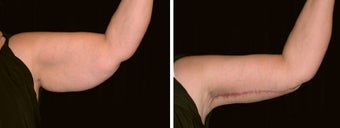 53 year old female, arm lift