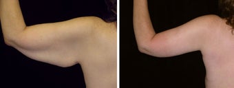 39 year old female, arm  lift