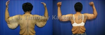 Before and after picture arm lift arm reduction after massive weight loss gastric bypass female african american back view 