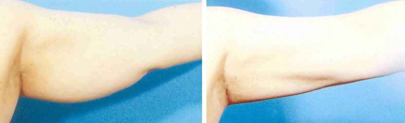 Arm Liposuction
