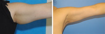 Arm Liposuction