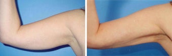 Arm Liposuction