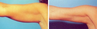 Arm Liposuction